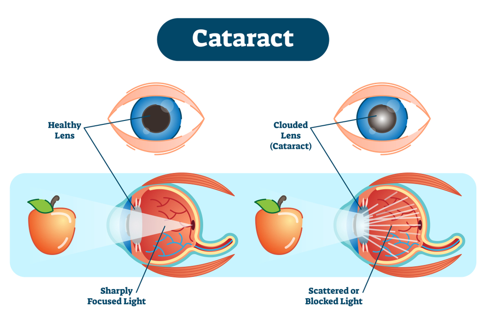 Cataract Surgery in Delhi NCR