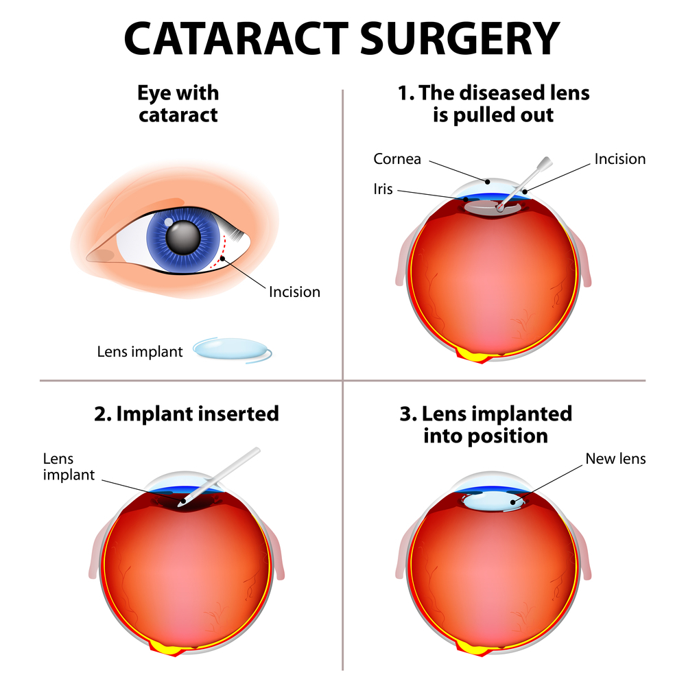 Cataract Surgery Procedure