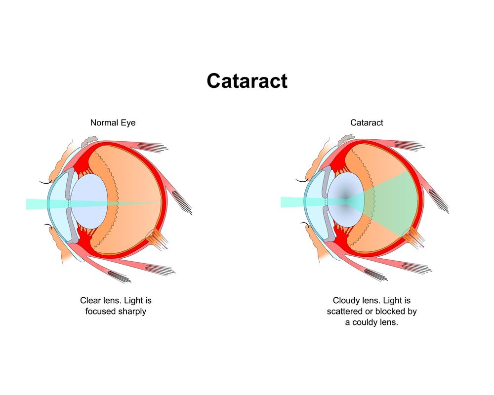 All you need to know about cataract
