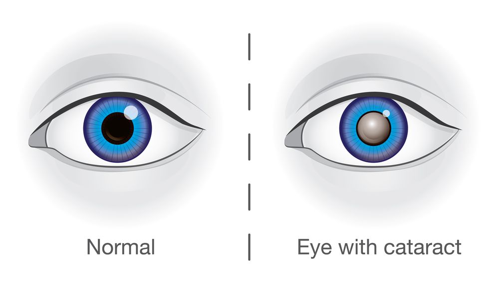 Cataract Causes