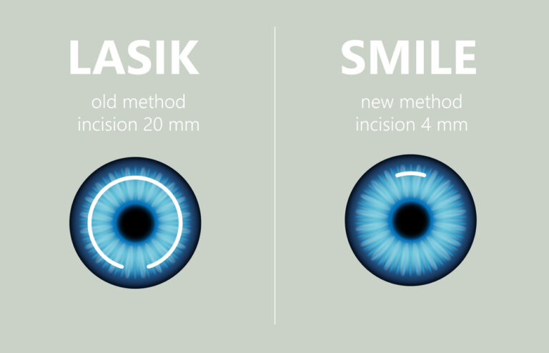 ReLEx Smile Eye Surgery In Delhi Best Doctors Cost Hospital relex-smile-eye-surgery-in-delhi-best-doctors-cost-hospital