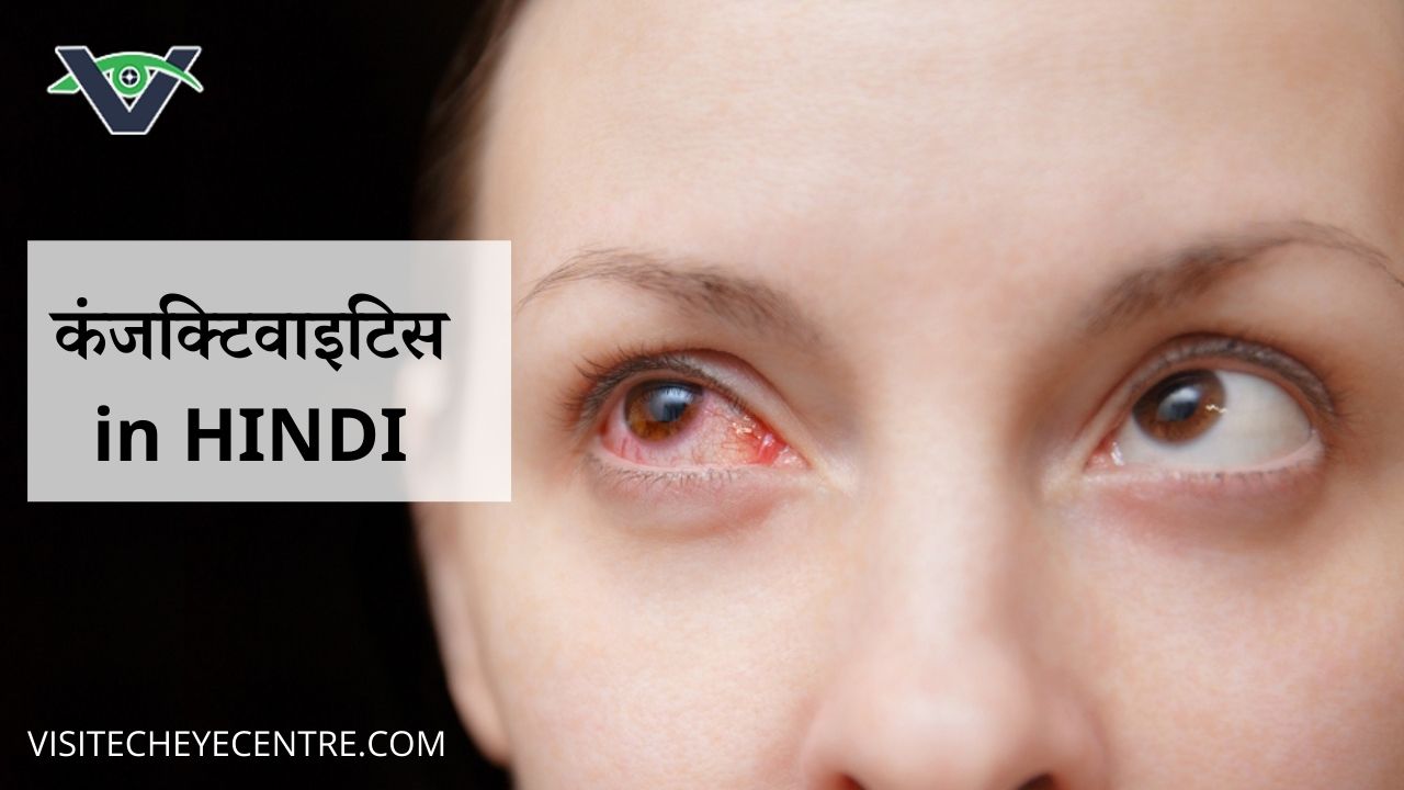 कंजक्टिवाइटिस (आँख आना) कारण, लक्षण एवं इलाज