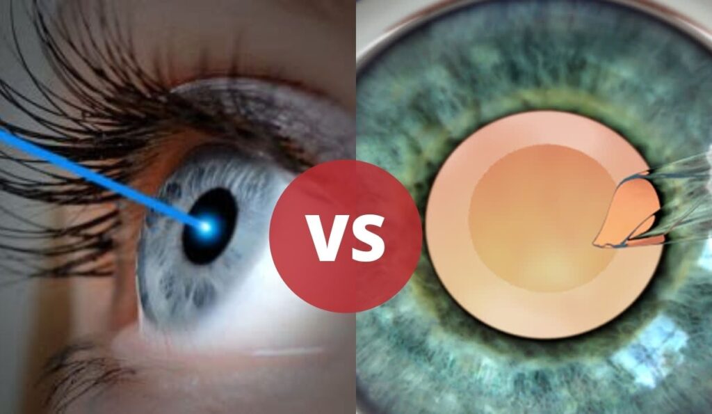 LASIK Eye Surgery Vs Lens Implant