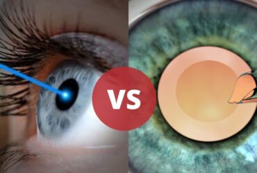 LASIK Eye Surgery Vs Lens Implant