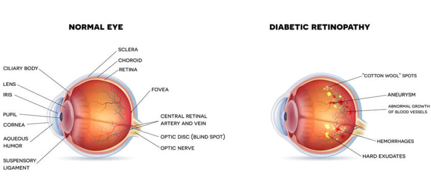 Diabetic Eye Problems