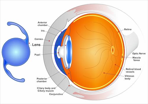 IOL Cataract Surgery in Delhi