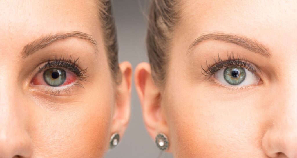 Red Eyes Causes and Treatment