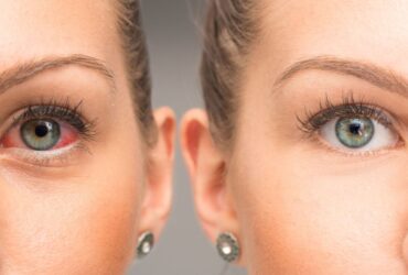 Red Eyes Causes and Treatment