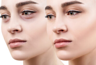 eye bags Causes and Treatment