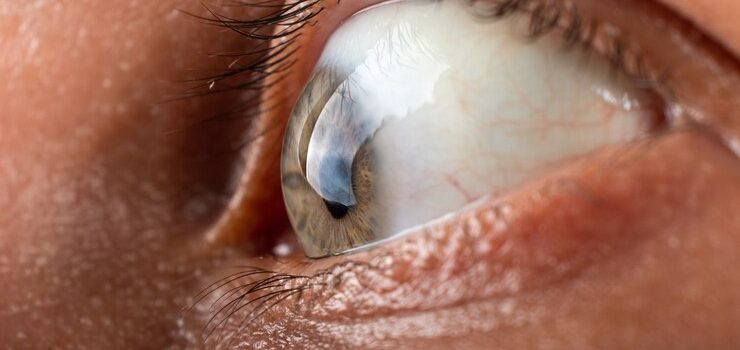 corneal blindness