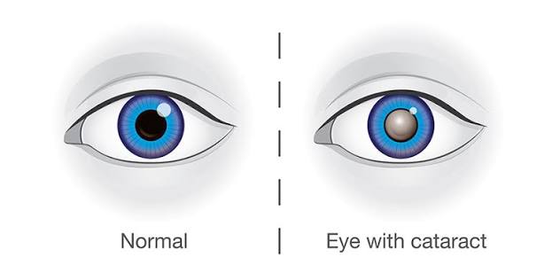 Best Cataract Surgery & IOL Centre in South Delhi